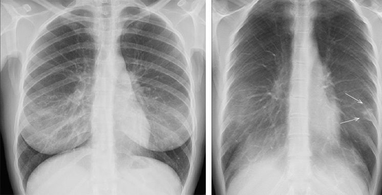 Crean una nueva herramienta de detección de Covid basada en imágenes pulmonares. Foto: Europa Press 