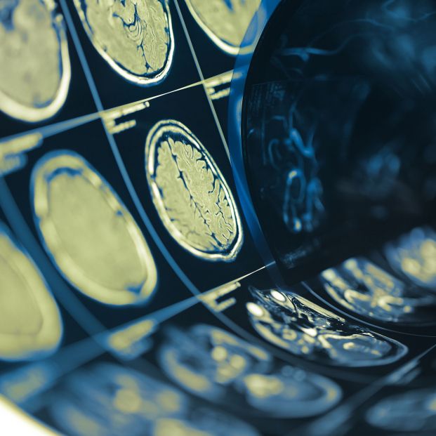 Investigadores descubren el gen regulador del cáncer cerebral con peor pronóstico. FOTO: Bigstock 