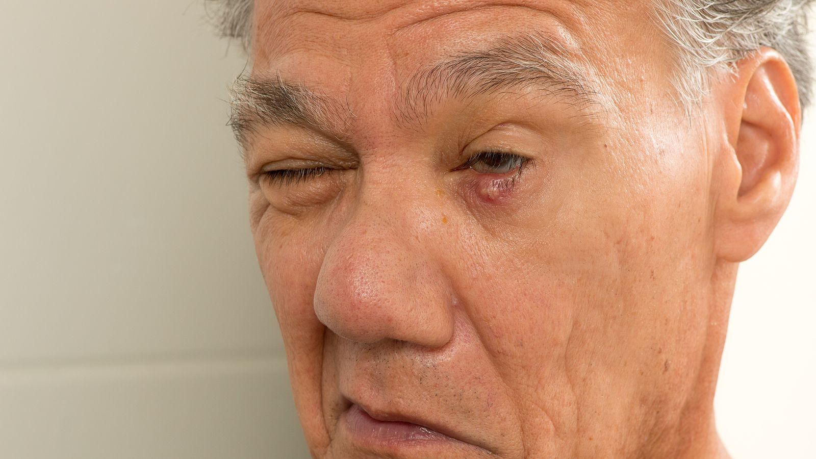 Orzuelos: por qué aparecen realmente y qué hacer para prevenirlos