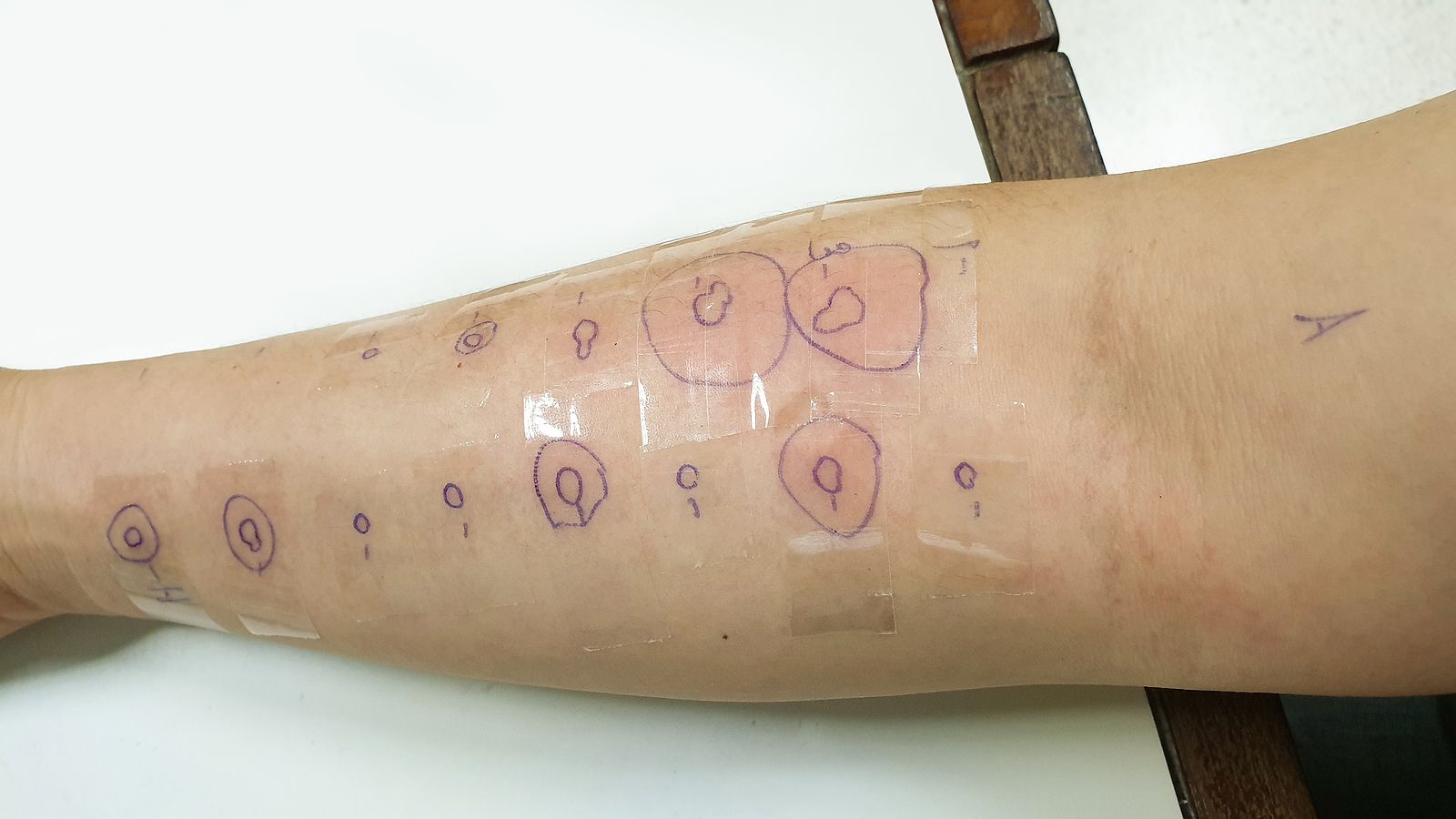 Fácil y barato: un nuevo test español detecta la inmunidad al Covid con una reacción cutánea