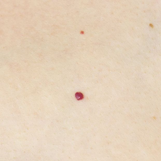 Qué son los puntos rojos en la piel y por qué aparecen