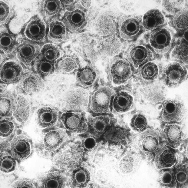 Hayan pruebas de la posible relación entre el herpes simple y las enfermedades neurodegenerativas. Foto: Europa Press