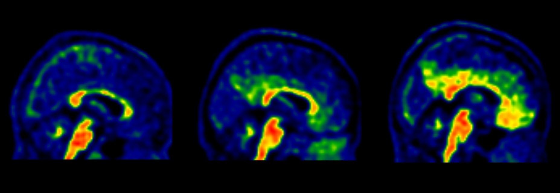 identifican tres categorías de genes implicadas en el Alzheimer