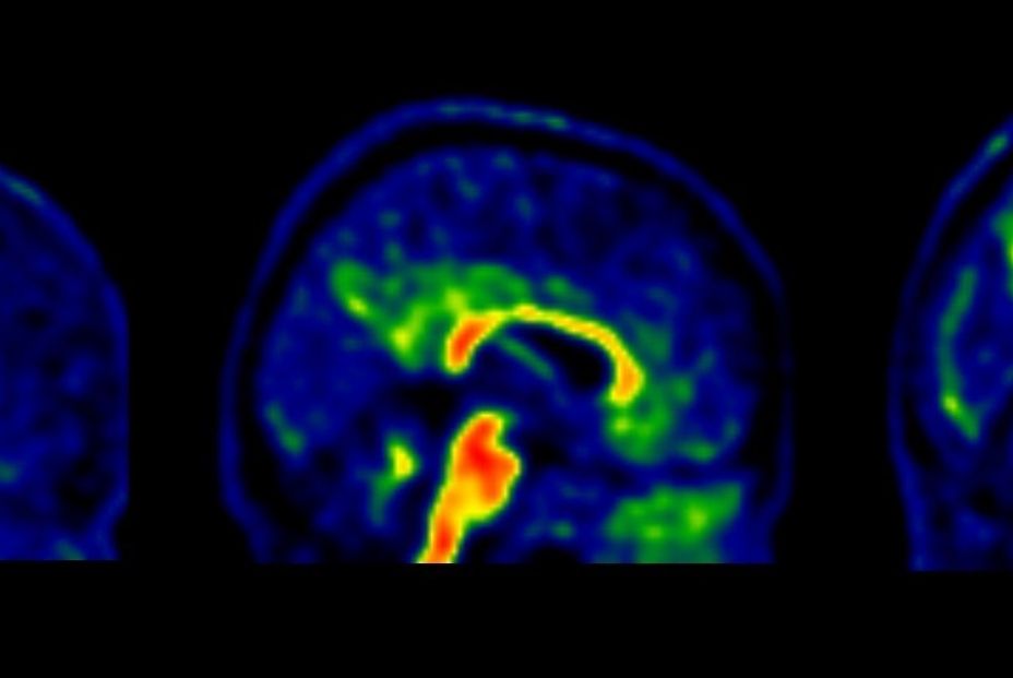 identifican tres categorías de genes implicadas en el Alzheimer