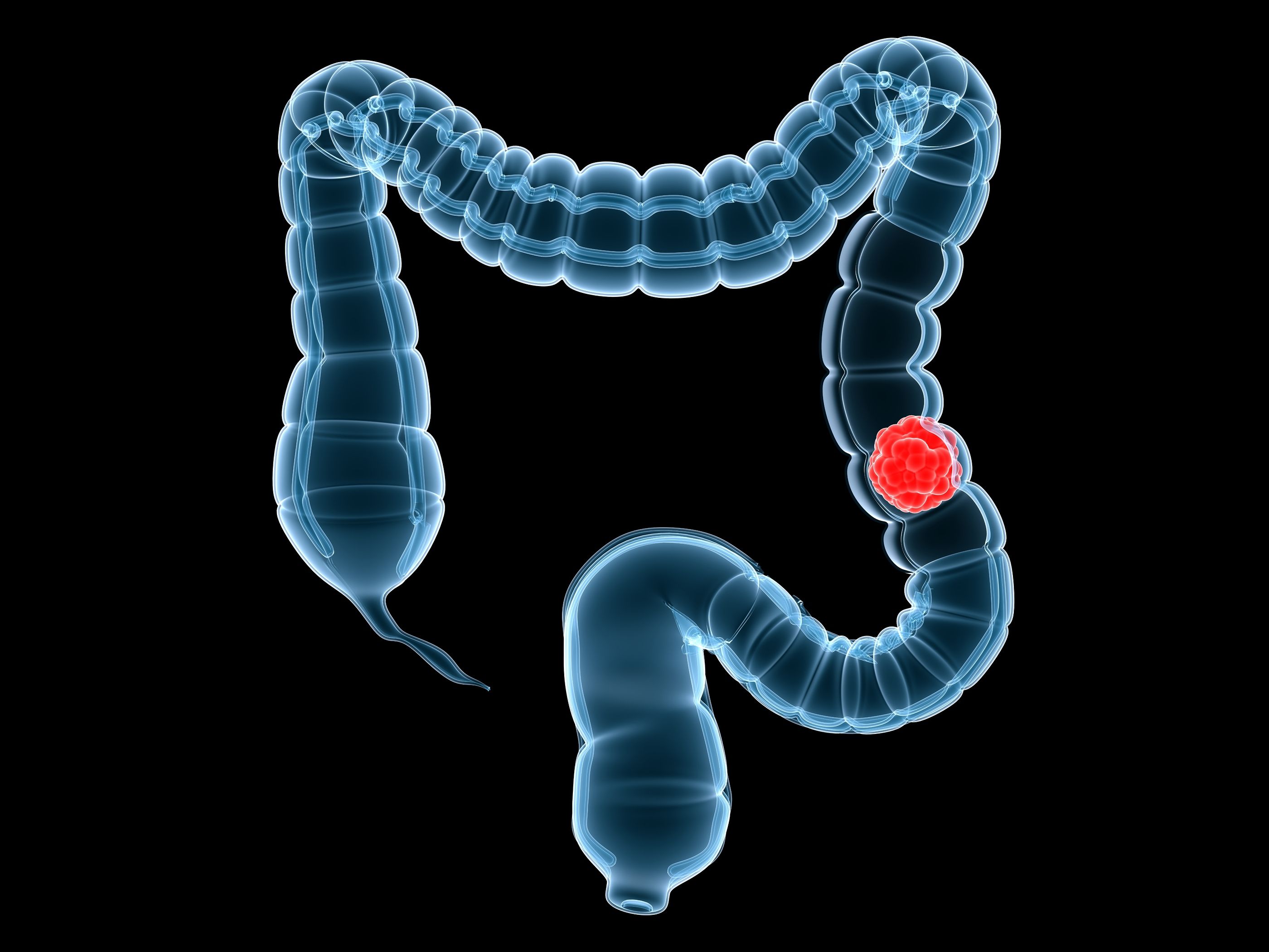 Un fármaco logra que el cáncer de colon remita totalmente en todos los pacientes de un estudio