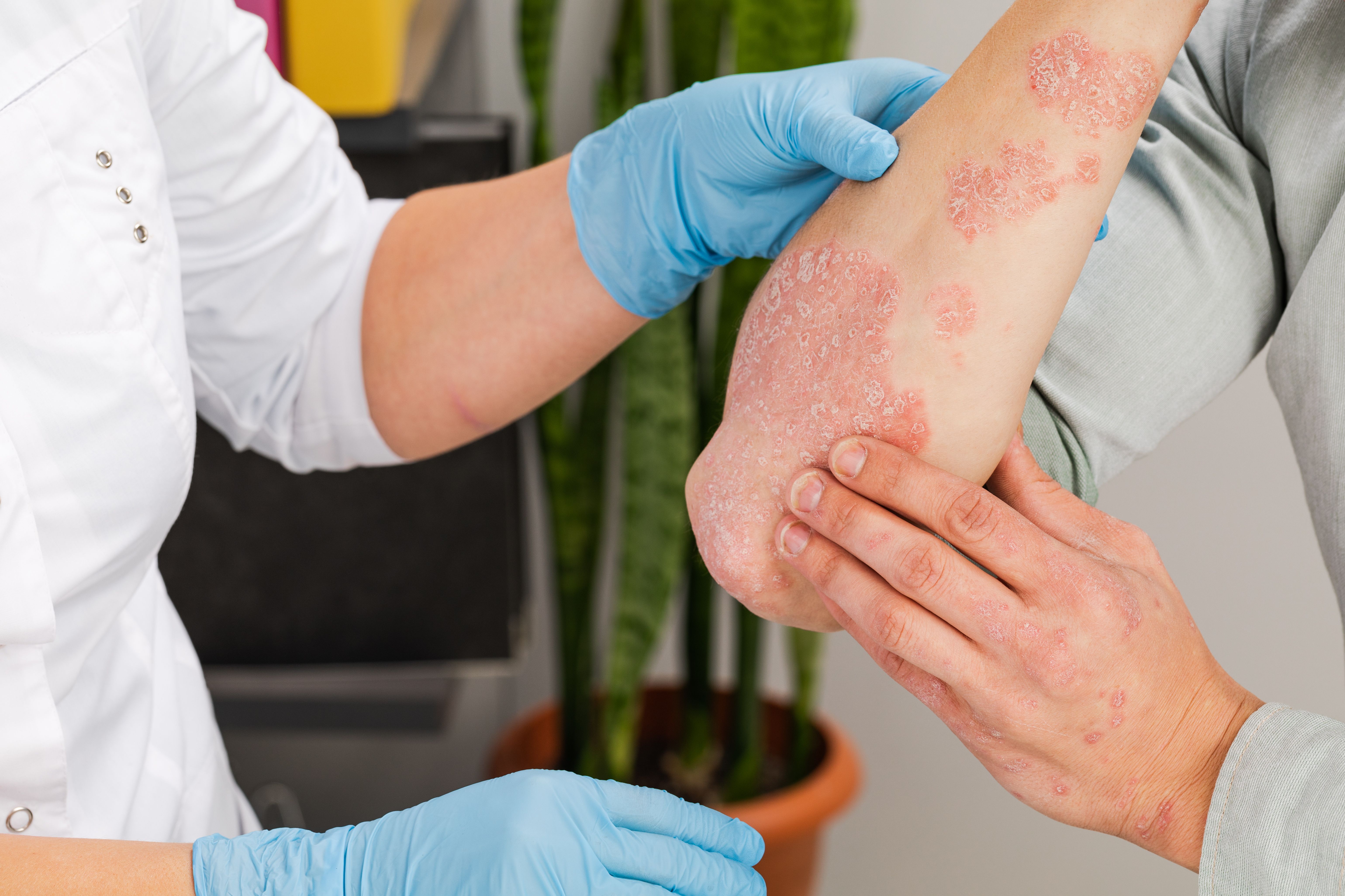 Psoriasis, descamación de la piel