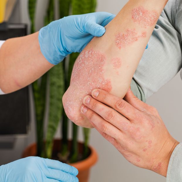 Psoriasis, descamación de la piel Psoriasis, descamación de la piel