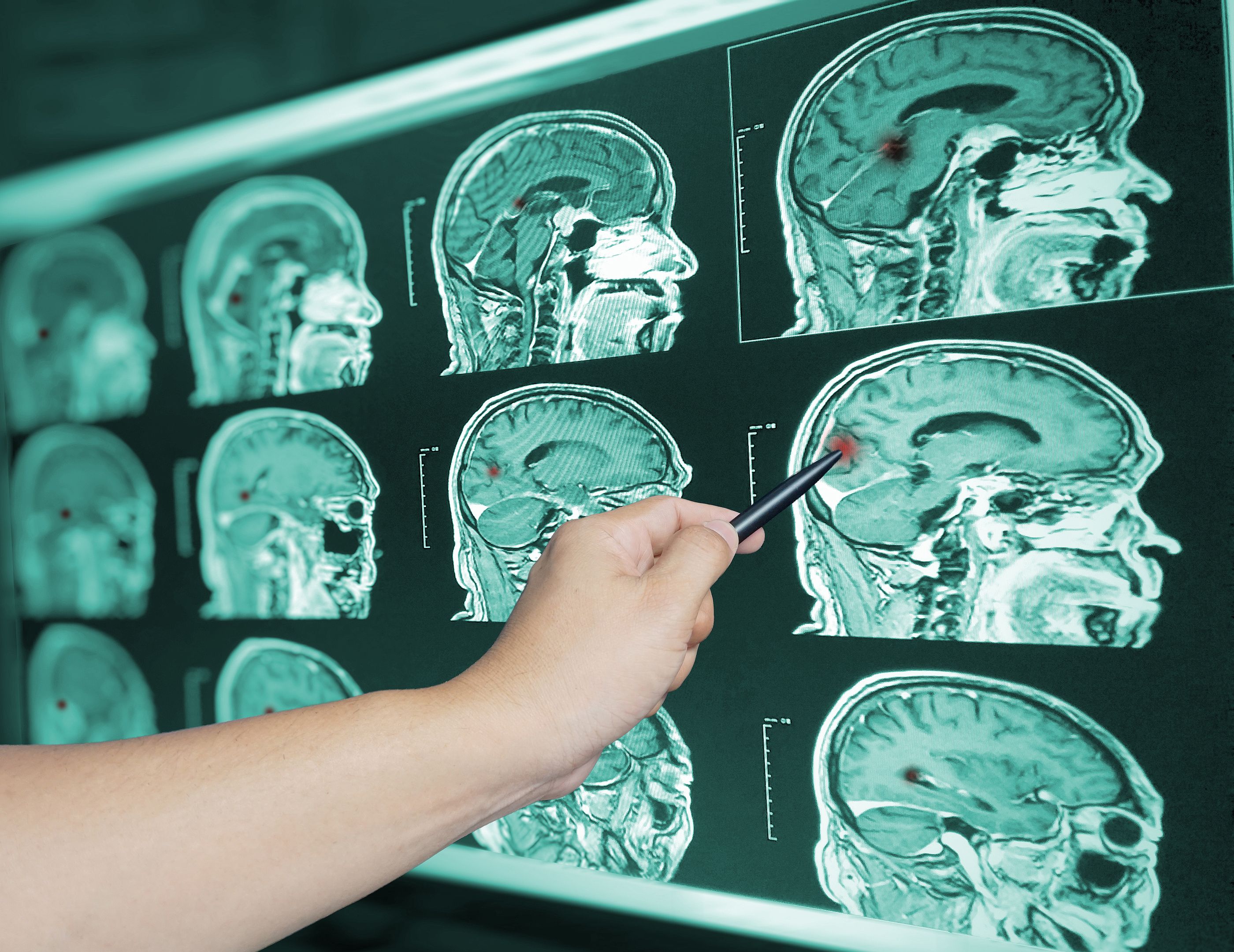 Buena noticia para el riesgo de alzhéimer: los cerebros humanos son cada vez más grandes