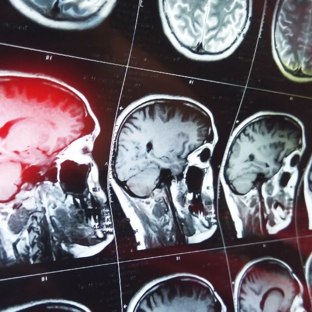 El descubrimiento que permitiría detectar el alzhéimer hasta 30 años antes de los primeros síntomas