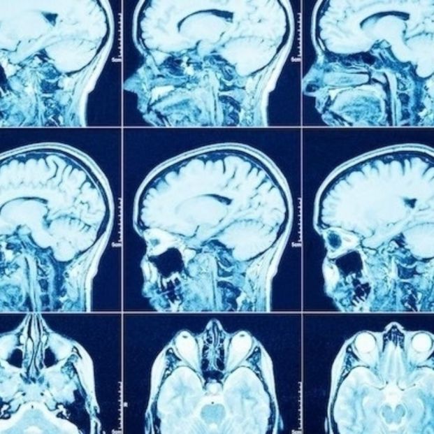 Antirretrovirales contra el VIH podrían ser eficaces frente a tumores cerebrales, según un estudio