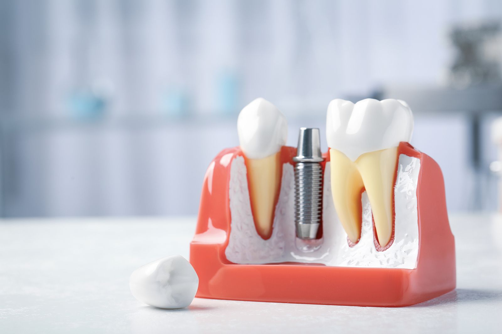 Estos son los posibles efectos secundarios de los implantes dentales