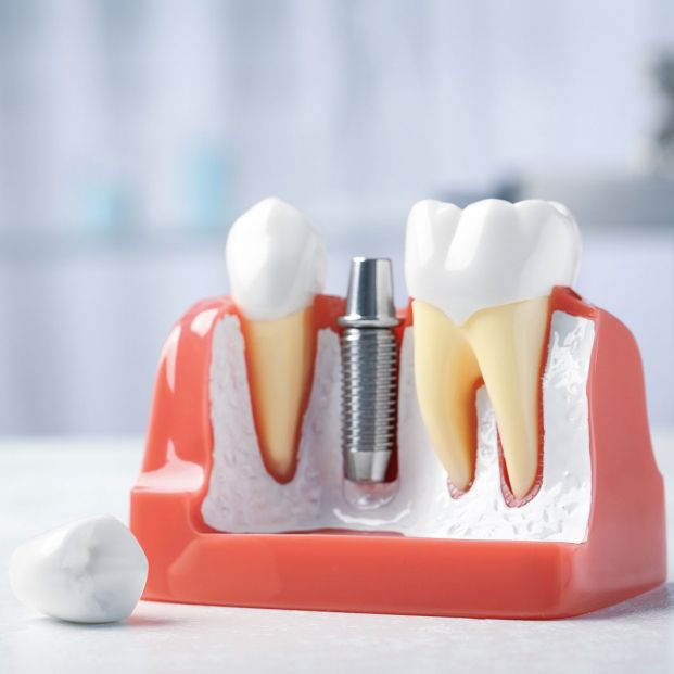 Estos son los posibles efectos secundarios de los implantes dentales