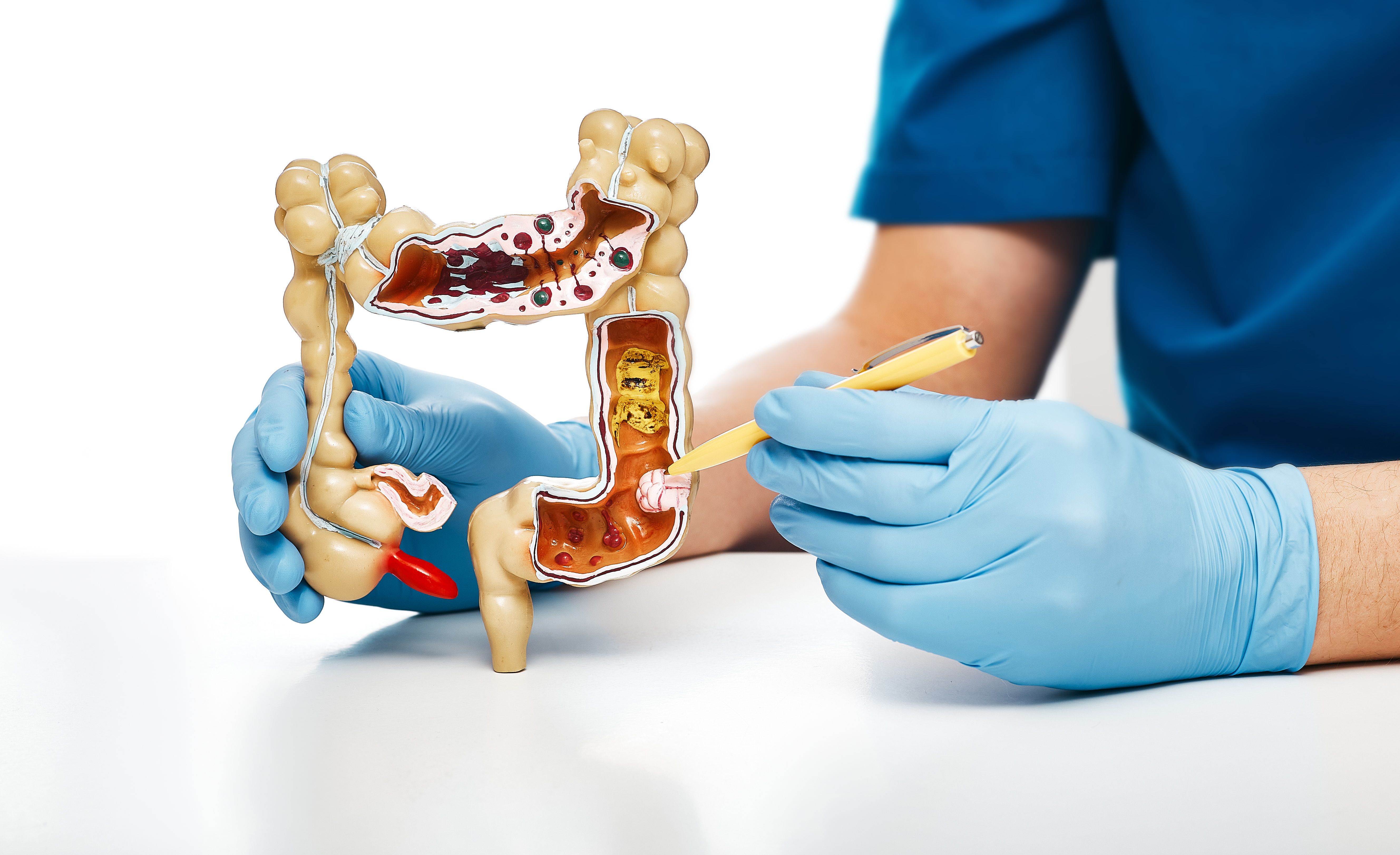 4 de los 8 tipos de cáncer más diagnosticados tienen relación con el aparato digestivo