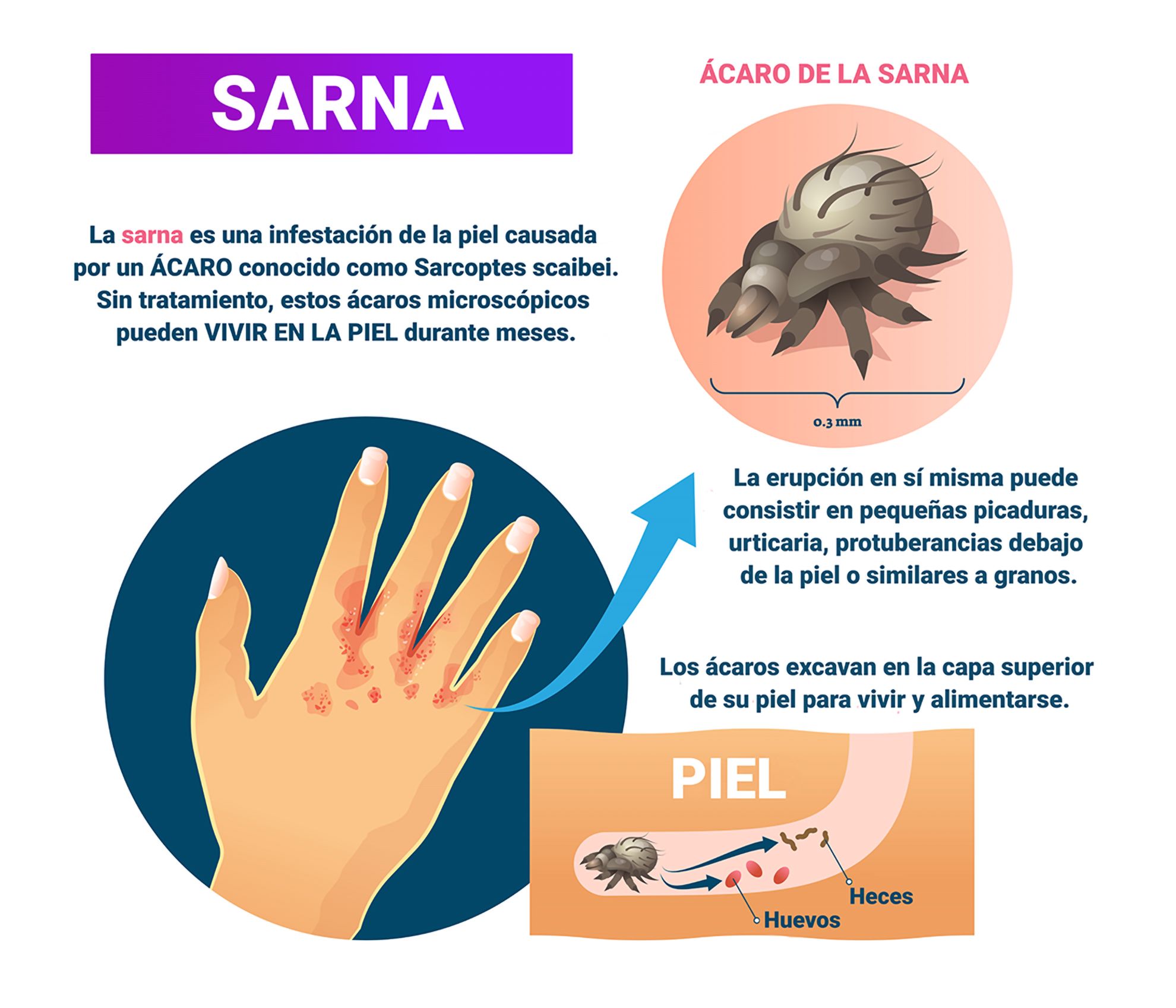  Sarna. Qué se sabemos de esta enfermedad que afecta a la piel 6