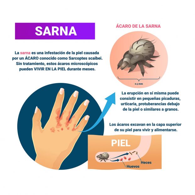  Sarna. Qué se sabemos de esta enfermedad que afecta a la piel