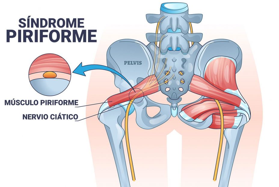 La falsa ciática. Un dolor muscular incapacitante