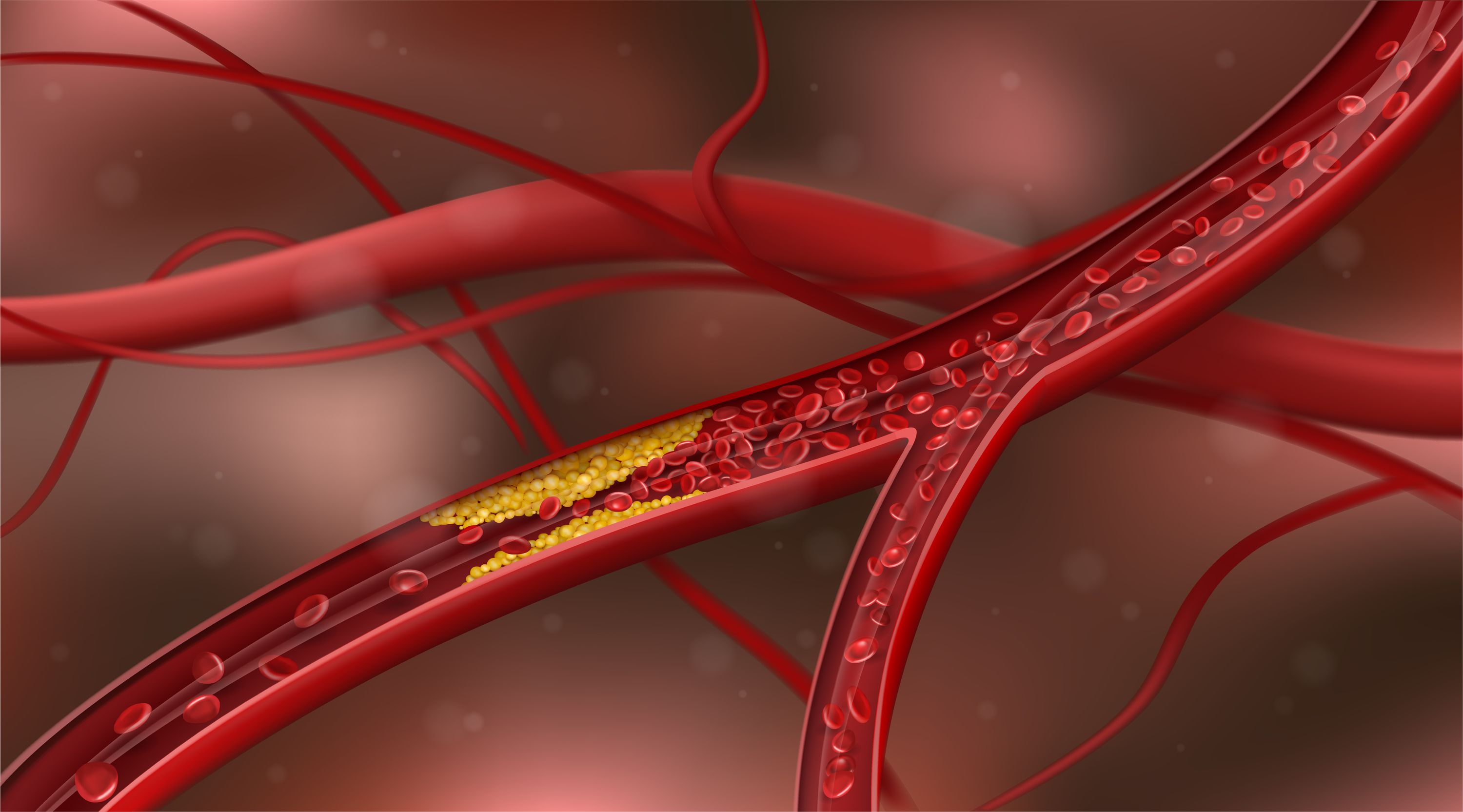 Nuevo golpe al colesterol: esta es la nueva técnica que consigue 'limpiar' las arterias