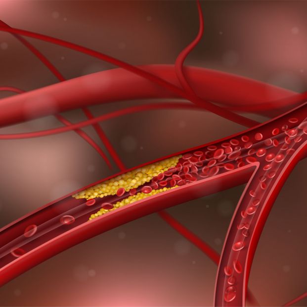 Nuevo golpe al colesterol: esta es la nueva técnica que consigue 'limpiar' las arterias
