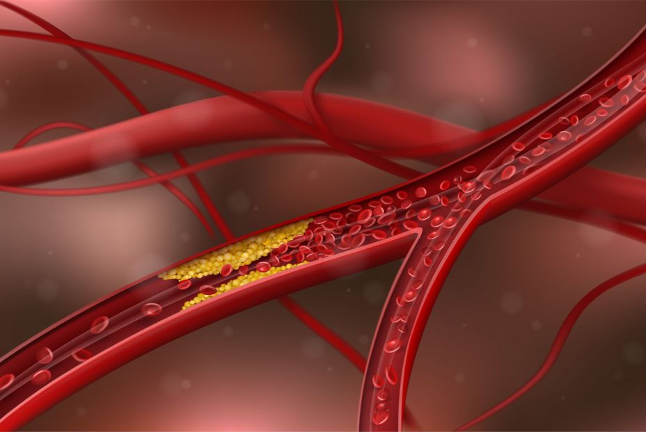 Nuevo golpe al colesterol: esta es la nueva técnica que consigue 'limpiar' las arterias